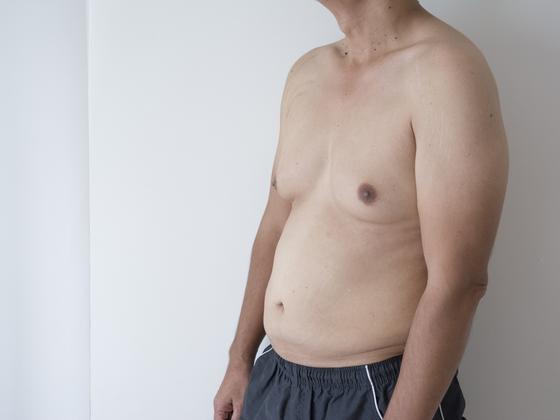 gynecomastia-near-Kompally-hyderabad